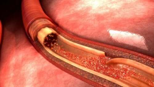 Aortan repeämä: mikä se on ja mistä se johtuu