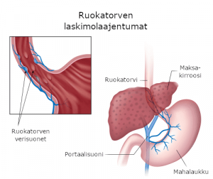 Ruokatorven laskimolaajentumat