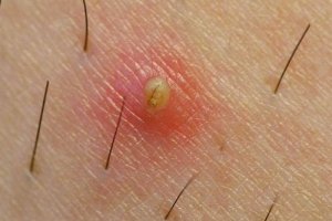 Ehkäise ihokarvojen kasvu sisäänpäin