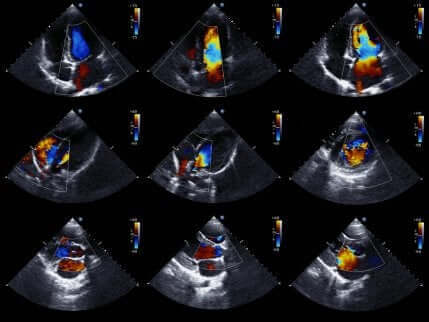 sydämen ultraäänitutkimus