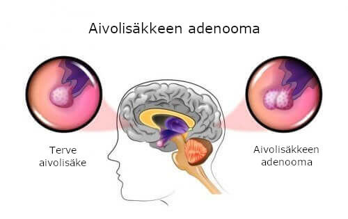 Aivolisäkkeen adenooman aiheuttajat ja oireet