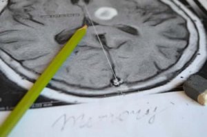 Amnesian oireet ja ehkäisy