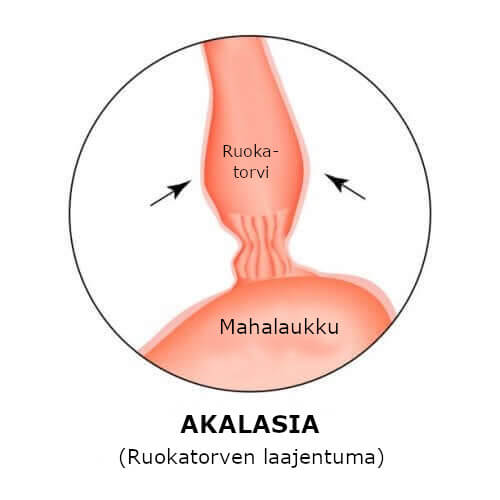 Ruokatorven akalasia: oireet ja hoito - Askel Terveyteen