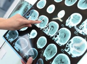 Vakava neurokognitiivinen häiriö (dementia)