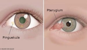 Sarveiskalvon kasvaimet: pinguekula ja pterygium