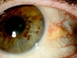 Jos pinguekula aiheuttaa silmää ärsyttäviä oireita, voi silmälääkäri suositella kosteuttavien silmätippojen käyttöä