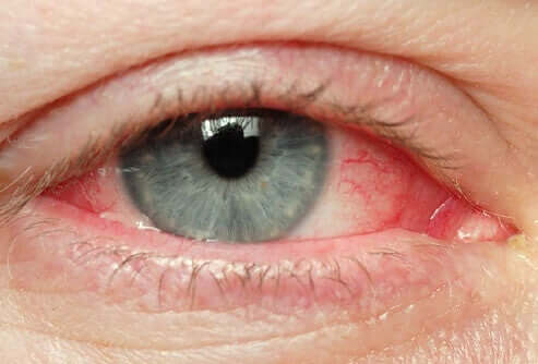 Pinguekulan yleisimpiä oireita ovat esimeriksi silmän kutina, silmämunan punoitus sekä silmien kuivuminen