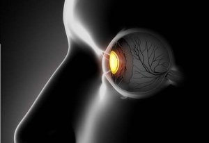 Silmien karsastus: oireet ja hoito