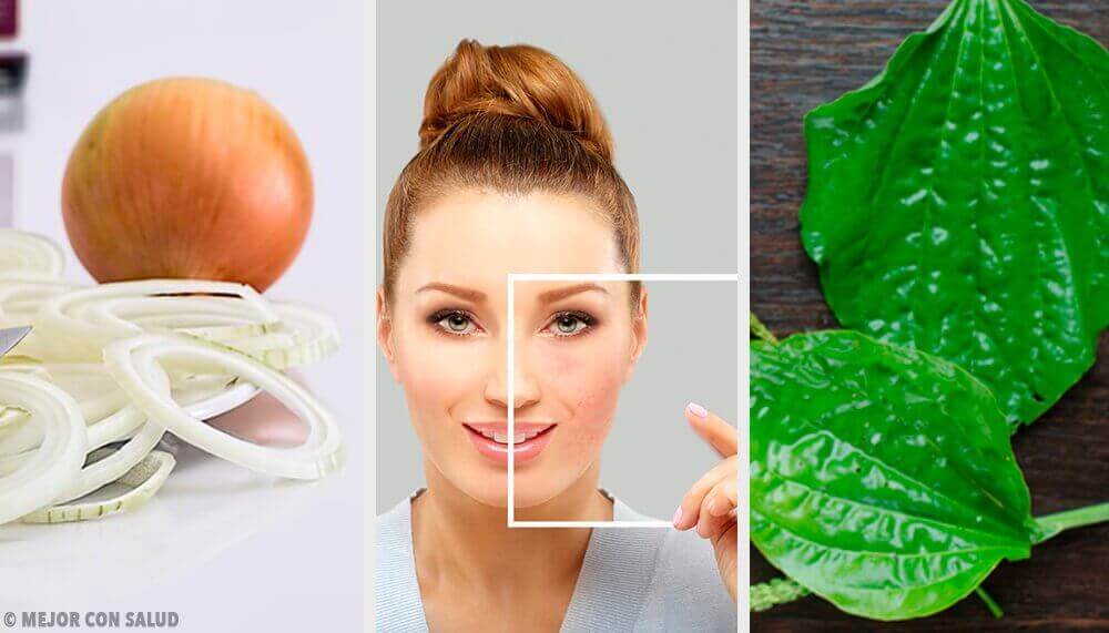 Kasvojen läiskien poisto luontaistuotteilla