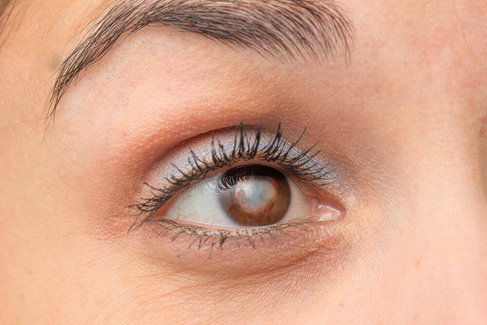 Kaihin oireet voivat muistuttaa vähemmän vakavien silmäongelmien oireita