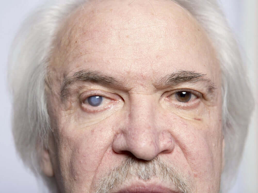 Kaihi näkyy silmässä vaaleana samentumana