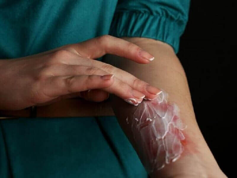 Kotihoitoja luonnonjogurtista palovammoille.