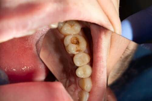 Hammaskaries: mikä hampaiden reikiintymistä aiheuttaa?