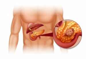 Haiman neuroendokriinisten kasvainten diagnoosi ja hoito