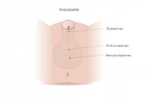 Hypospadia: oireet, riskitekijät ja hoito