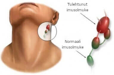 Normaali imusolmuke ja tulehtunut imusolmuke.
