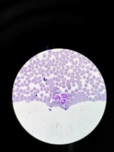 Jyvässolukato: oireet ja hoito