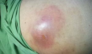 Vatsan märkäpesäkkeet: oireet ja hoito