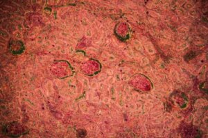 Munuaisten tuberkuloosin diagnoosi ja hoito