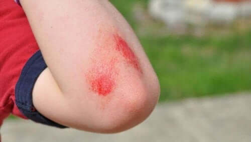 Pinnallisia haavoja ja naarmuja voidaan hoitaa luonnollisesti