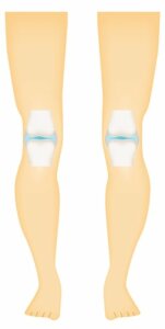 Synoviaalinivelten eri tyypit ja niiden ominaisuudet