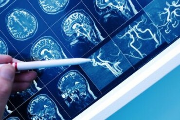 Vaskulaarinen dementia: oireet ja hoito