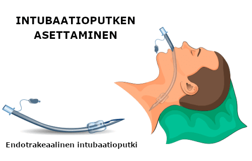 Intubaatioputken asettaminen