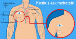 Vaskulaarinen perforaatio ja keskuslaskimokatetrit