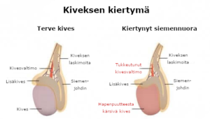 Kiveksen kiertymä: oireet ja syyt
