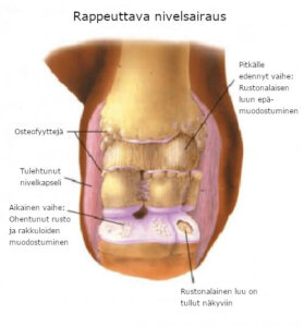 Rappeuttava nivelsairaus: aiheuttajat ja hoito