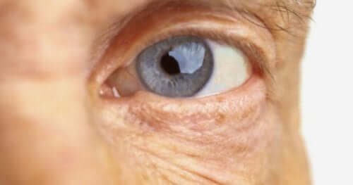 Silmänpohjan ikärappeuman aiheuttajat ovat edelleen tuntemattomia