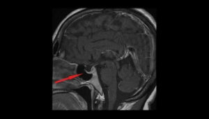 Mikä aivolisäkkeen adenooma on?