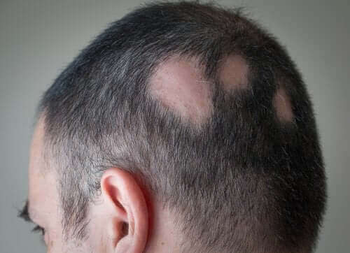 Alopecia ilmenee kaljuina läiskinä miehillä