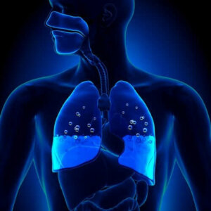 Keuhkoödeema: oireet ja aiheuttajat
