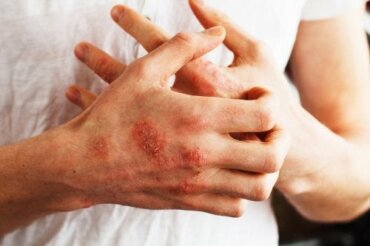 Ravitsemusvinkkejä psoriasiksen oireiden hallitsemiseksi