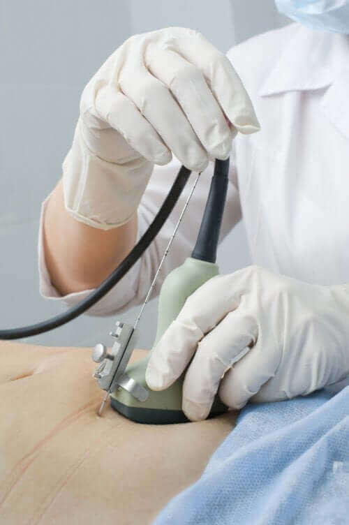 Adenomyoosi voidaan diagnosoida ultraäänellä