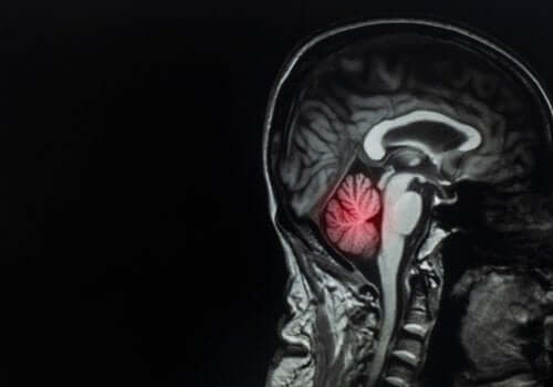 Aivojen etäpesäkkeet: määritelmä ja hoito