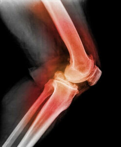 Polvilumpion sijoiltaanmeno: mitä siitä tulee tietää