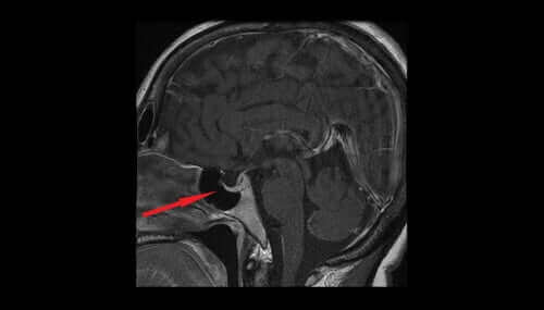 Vasopressiini syntyy hypotalamuksessa