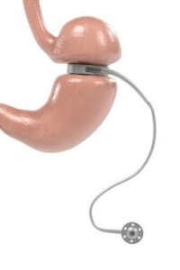 Säädettävä mahapanta: käyttötarkoitus ja hyödyt