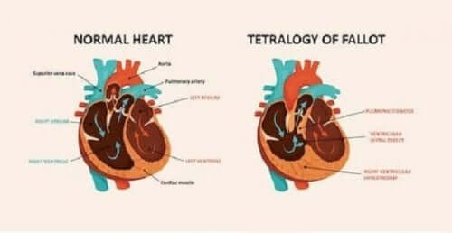 Terve sydän ja synnynnäinen sydänsairaus.