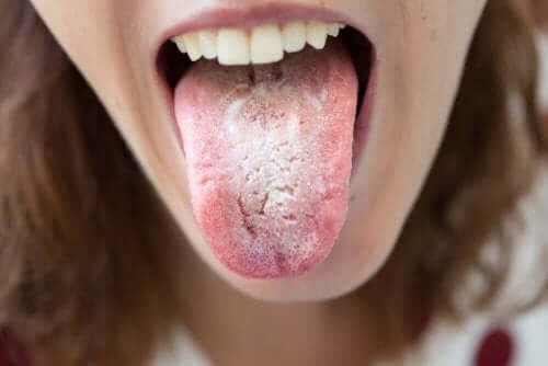 Mustat läiskät kielessä voivat johtua sieni-infektiosta