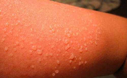 Joillakin koronaviruspotilailla on esiintynyt iho-oireita