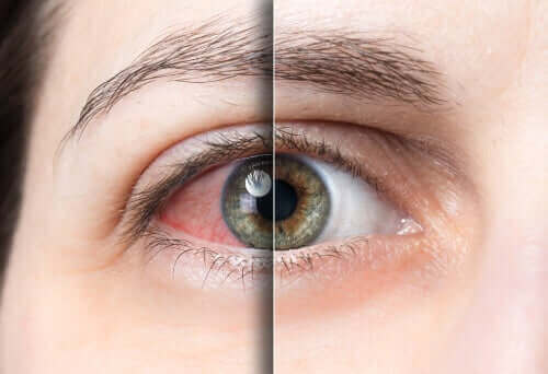 Silmän sidekalvotulehdus on koronaviruksen uusi oire