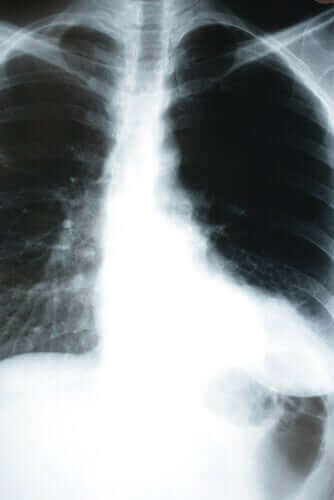 Oireeton keuhkokuume voi olla koronavirustartunnan oire.