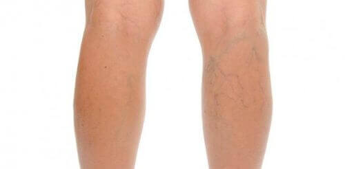 Venoruton on lievään laskimoiden vajaatoimintaan käytettävä lääke