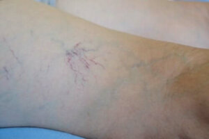 Venoruton – ominaisuudet ja käyttötavat