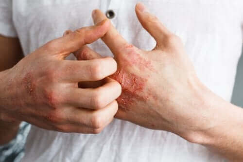 Mikä on atooppinen dermatiitti?