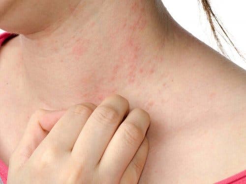 Atooppinen dermatiitti ilmenee näppylöinä iholla.