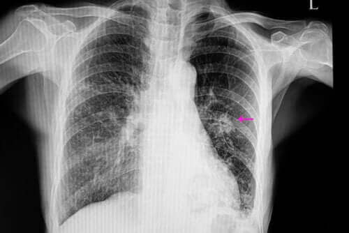 Mikä on keuhkopaise?